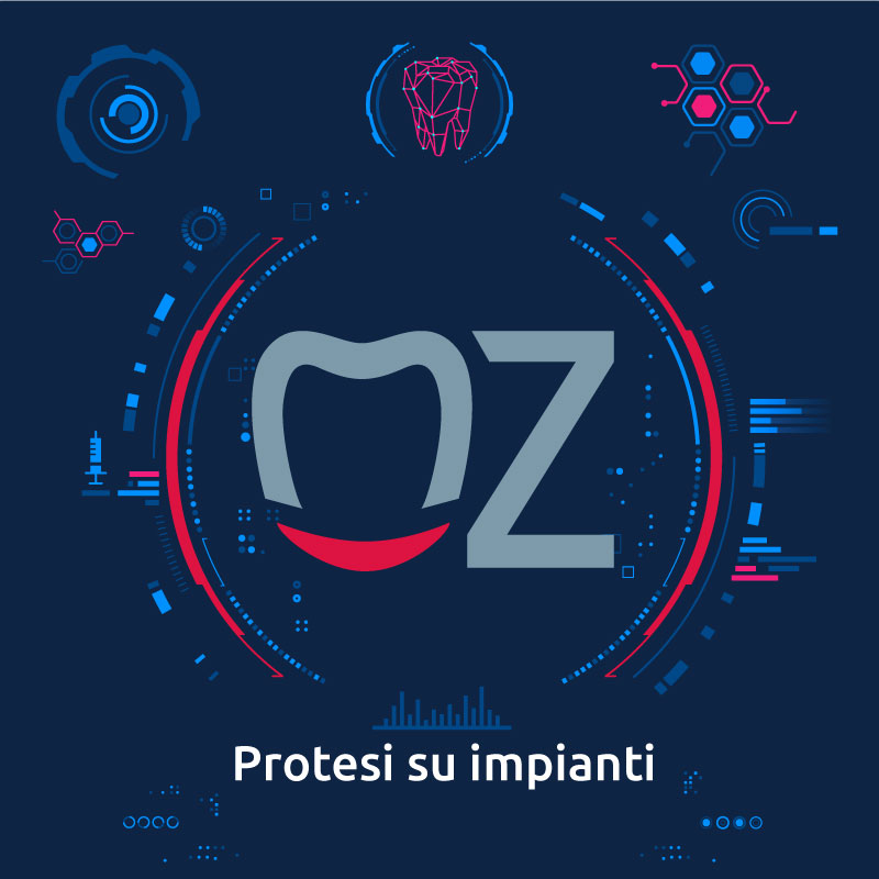 Protesi su impianti – Soluzioni personalizzate e tecnologicamente avanzate